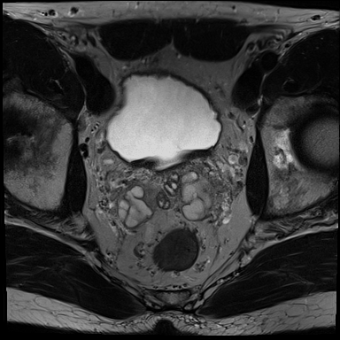 Prostate mpMRI Imaging